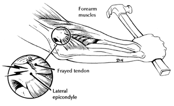 Tennis elbow